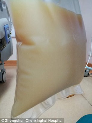 中山男子腹痛緊急送醫搶救，檢出“牛奶血”！