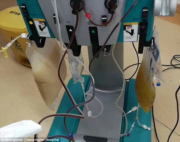 中山男子腹痛緊急送醫搶救，檢出“牛奶血”！