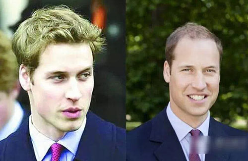 為什么男性禿頭都禿成一個樣？心疼男神們的發際線