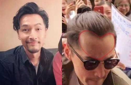 為什么男性禿頭都禿成一個樣？心疼男神們的發際線