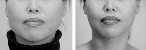 Botox shock: Teenagersare doing it