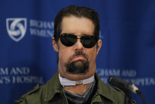First US face transplant patient makes debut