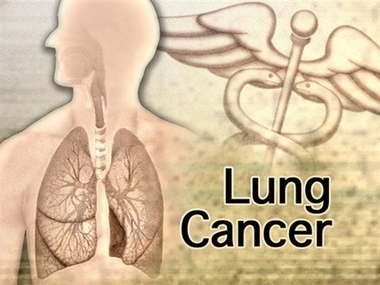 Scientists in Taiwan have developed a simple, five-gene test aimed at showing which lung cancer patients most need chemotherapy, as similar tests now do for people with breast cancer and lymphoma. The experimental test needs to be validated in larger groups of patients, so widespread use is perhaps a few years away. (AP