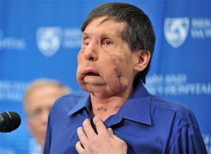 US face transplant man wants 'normal life'