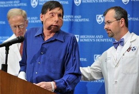 US face transplant man wants 'normal life'