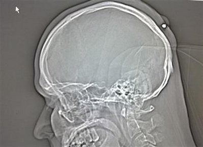 Man, shot in head, notices five years later